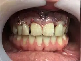 Immediate Implant: after treatment
