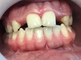 Immediate Implant: before treatment