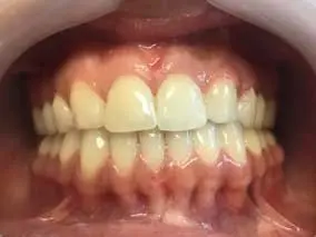 Space Closure by Componeer: after treatment