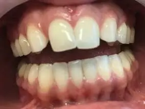 Space Closure by Componeer: before treatment