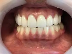 Veneers: after treatment
