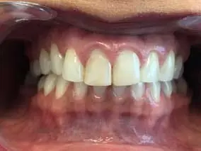 Veneers: before treatment